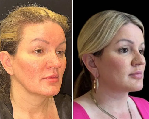 Awake Deep Plane Facelift and Necklift Right Oblique Side Photos