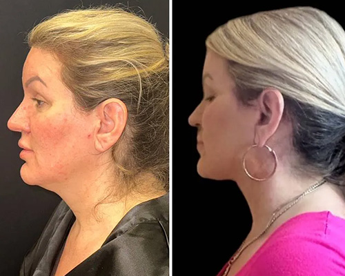 Awake Deep Plane Facelift and Necklift Left Side Photos