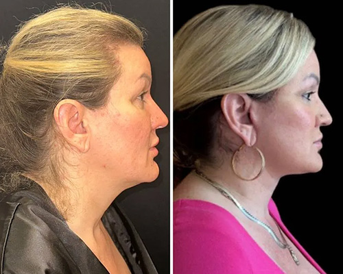 Awake Deep Plane Facelift and Necklift Right Side