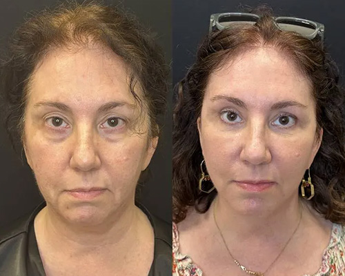 Facelift Before and After NYC