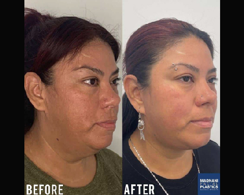 40-year-old Female Deep Plane Facelift Results