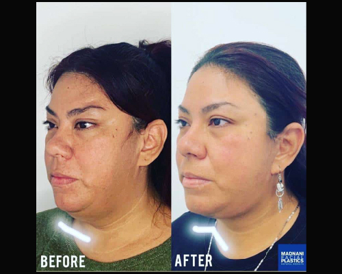 40-year-old Female Deep Plane Facelift Results After Weightloss