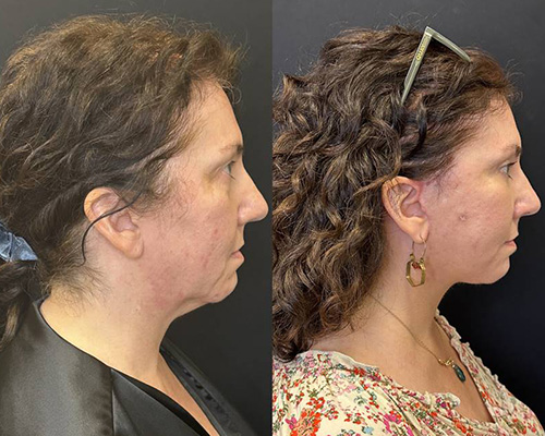 Facelift Before and After NYC Right Side Photo