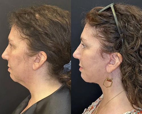 Facelift Before and After NYC Left Side Photo