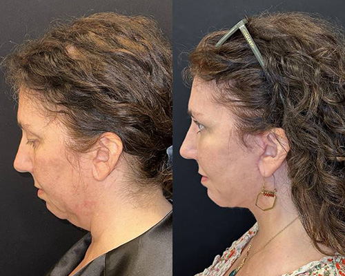 Facelift Before and After NYC Left Side View