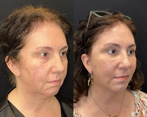 Facelift Before and After NYC Right Oblique