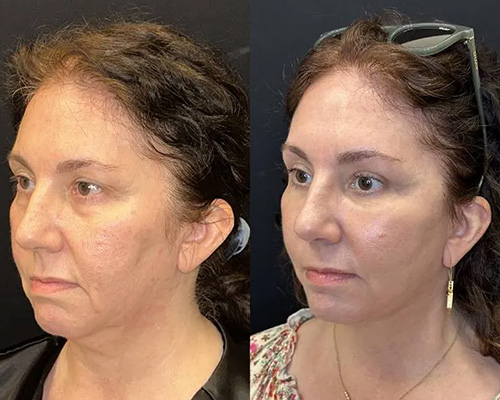 Facelift Before and After NYC Left Oblique