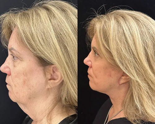 Facelift Before and After New York City