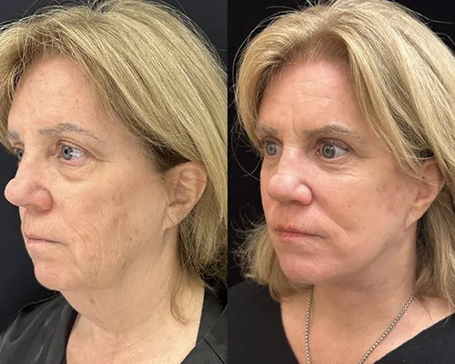 Facelift Before and After Left Oblique View New York City