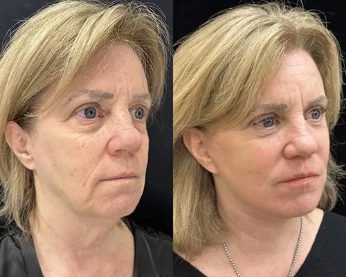 Facelift Before and After Right Oblique View New York City