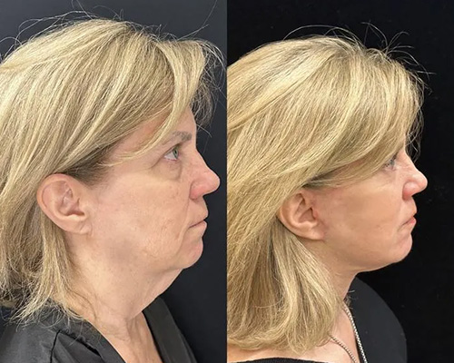 Facelift Before and After Side View New York City