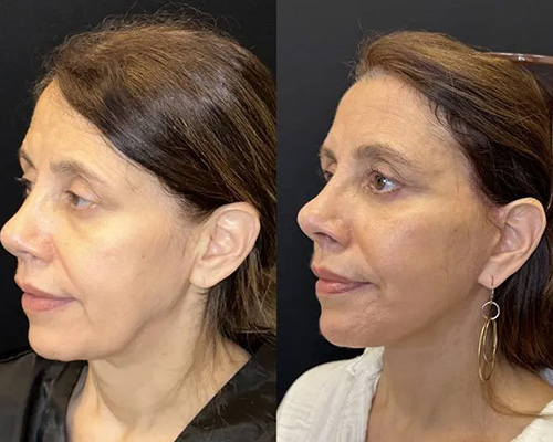 57 y.o female who underwent Awake Deep Plane Facelift