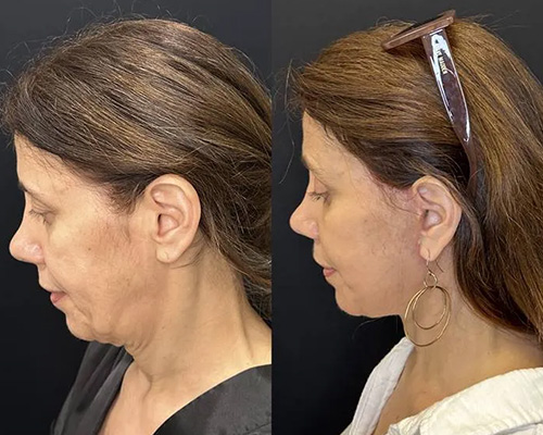 57 yo female who underwent Awake Deep Plane Facelift Before and After