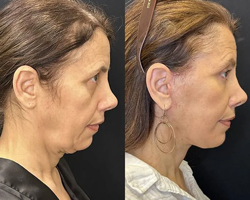 57 yo female who underwent Awake Deep Plane Facelift Photos