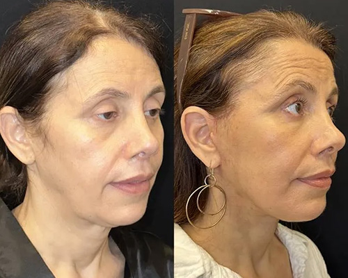 57 yo female who underwent Awake Deep Plane Facelift NYC