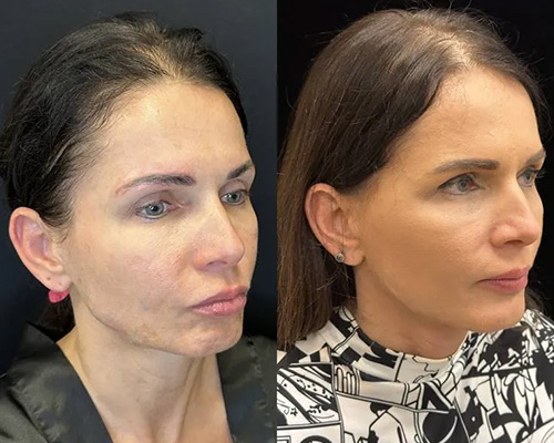 43 y/o female who underwent awake Deep Plane Facelift