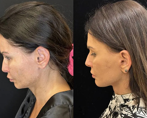 43 y/o female who underwent awake Deep Plane Facelift Photo