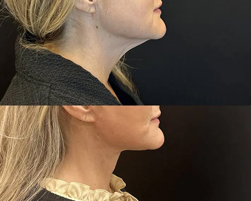 Awake Deep Plane Facelift and Necklift 1