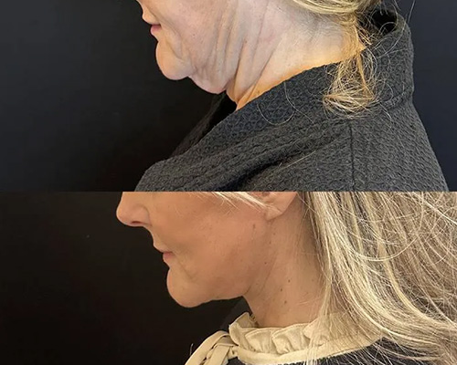 Awake Deep Plane Facelift and Necklift 4