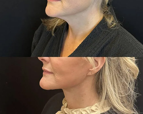 Awake Deep Plane Facelift and Necklift 3