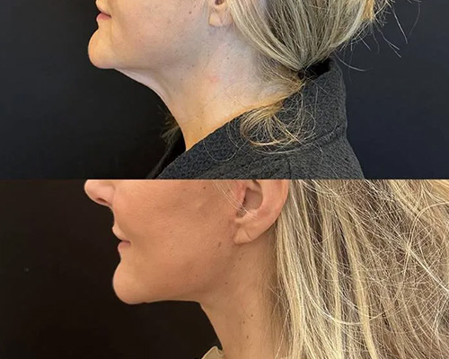 Awake Deep Plane Facelift and Necklift 2