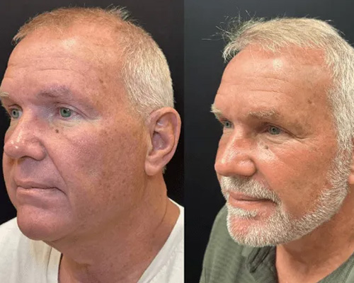 62-year-old male Deep Plane Facelift Before and After