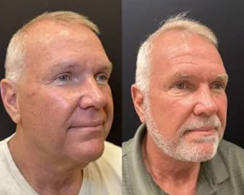 62-year-old male Deep Plane Facelift Before and After Photos NYC