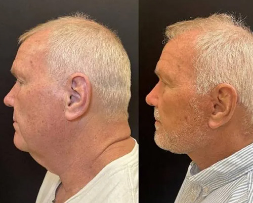 62-year-old male Deep Plane Facelift Before and After Left Side