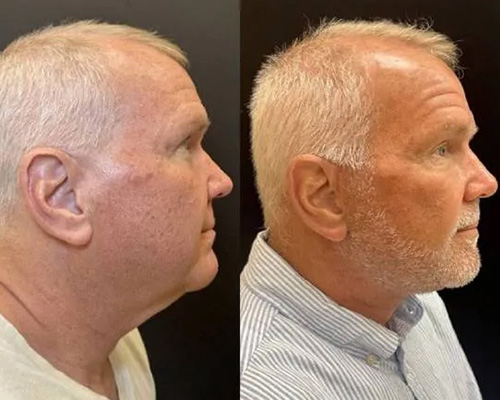 62-year-old male Deep Plane Facelift Before and After Right Side