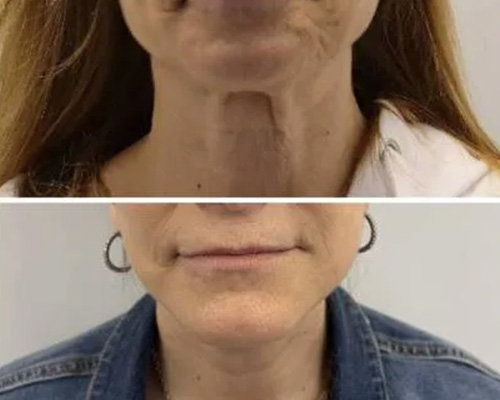 58-Year-Old Female Facelift Before and After Photos