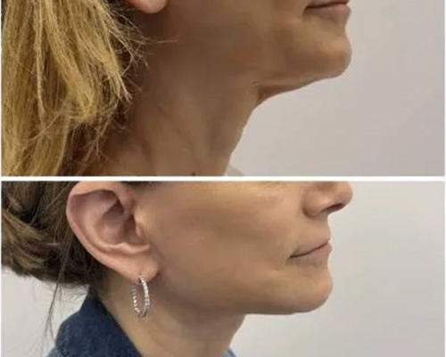 58-Year-Old Female Facelift Before and After Photos 5