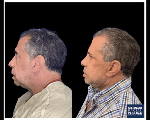 63-year-old Male Deep Plane Facelift Side View