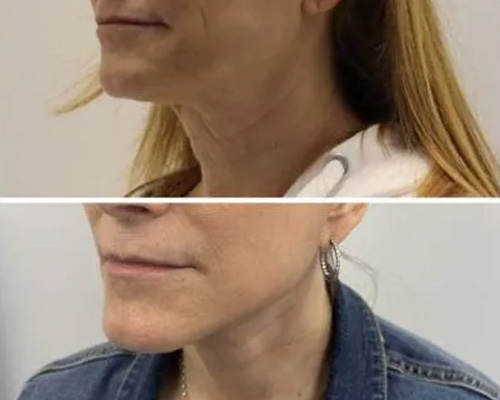 58-Year-Old Female Facelift Before and After Photos 4