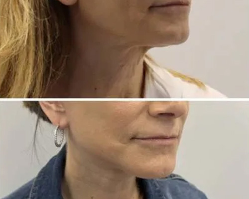 58-Year-Old Female Facelift Before and After Photos 3