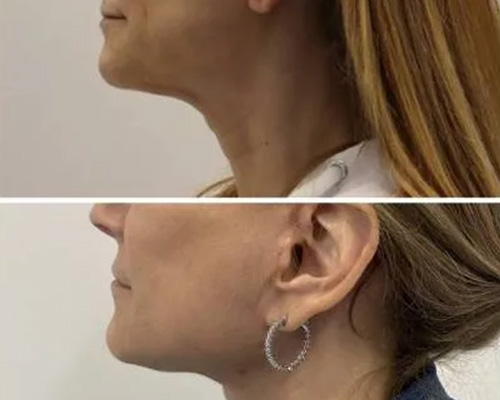 58-Year-Old Female Facelift Before and After Photos 2