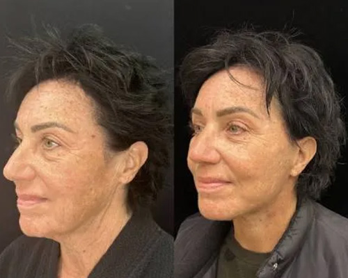 60-year-old Female 3 months After Awake Deep Plane Facelift Left Side