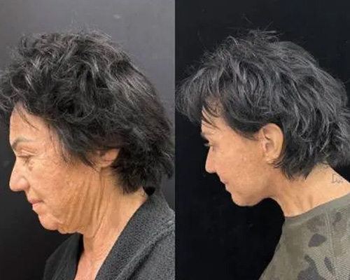 60-year-old Female 3 months After Awake Deep Plane Facelift