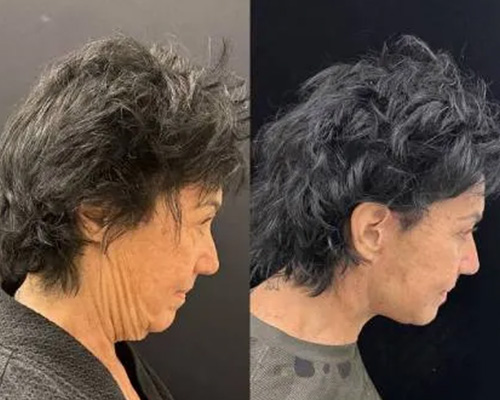 60-year-old Female 3 months After Awake Deep Plane Facelift 2