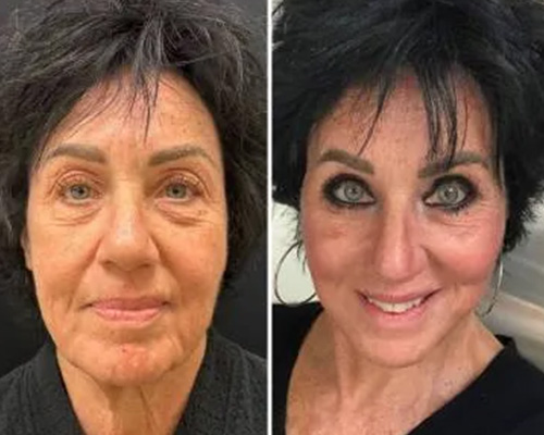 60-year-old Female 3 months After Awake Deep Plane Facelift Front