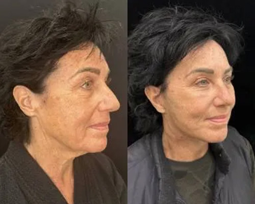 60-year-old Female 3 months After Awake Deep Plane Facelift Right Side