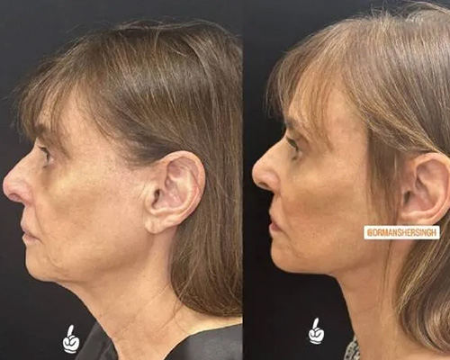 75-year-old female Facelift Before and After