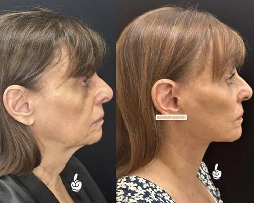 75-year-old female Facelift Before and After Right Side Photos