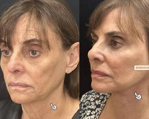 75-year-old female Facelift Before and After Left Oblique