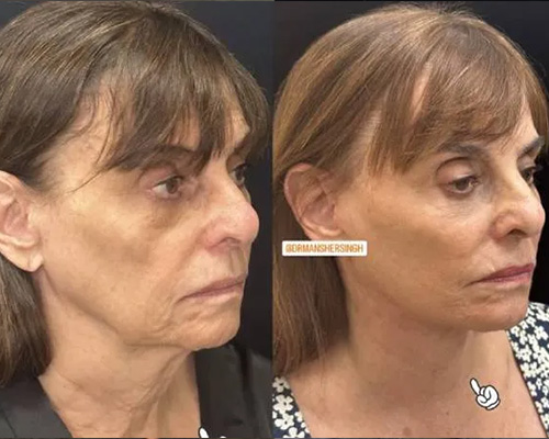 75-year-old female Facelift Before and After Right Oblique