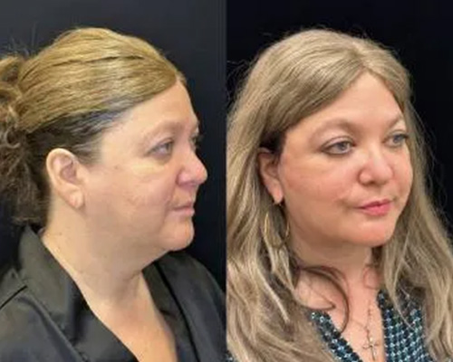 51 y/o female 1 Month Post Deep Plane Facelift