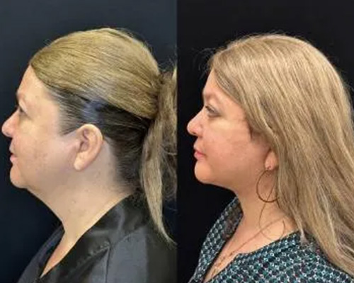 51 y/o female 1 Month Post Deep Plane Facelift Left Side View