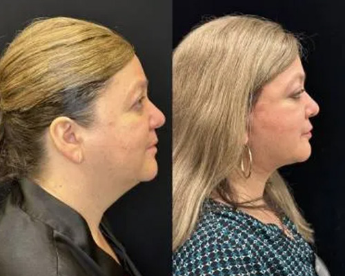 51 y/o female 1 Month Post Deep Plane Facelift Right Side View