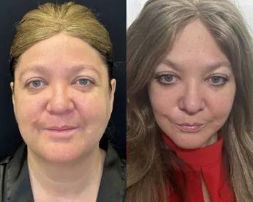 51 y/o female 1 Month Post Deep Plane Facelift Front View