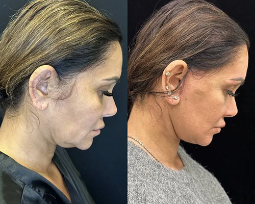 43-year-old Deep Plane Facelift postop Photo