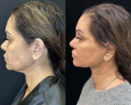 43-year-old Deep Plane Facelift postop Left Side View